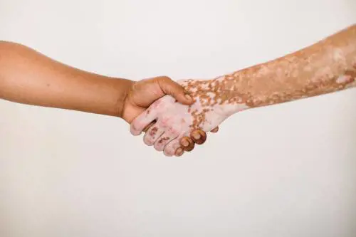 Vitiligine, ora l'Aifa rimborsa il primo trattamento specifico
