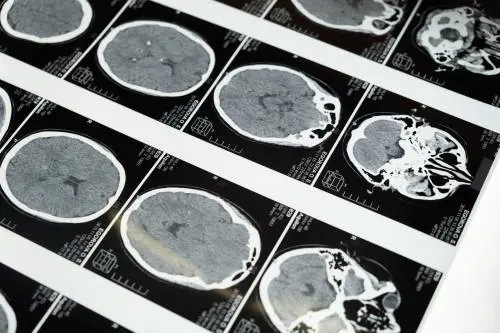 Estratto verme vivo dal cervello di una donna: primo caso al mondo