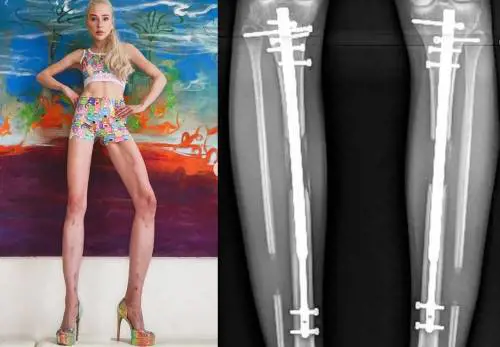 Paga 150mila euro per allungarsi le gambe di 14 centimetri. Ma ora si pente