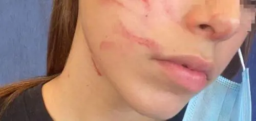 Eboli, 13enne picchiata in classe da una coetanea