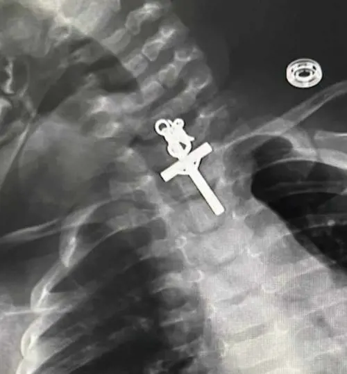 La radiografia della bimba