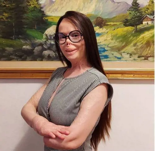 Valentina Pitzalis: "Il mio ex mi ha dato fuoco, ma io non ho perso il sorriso"