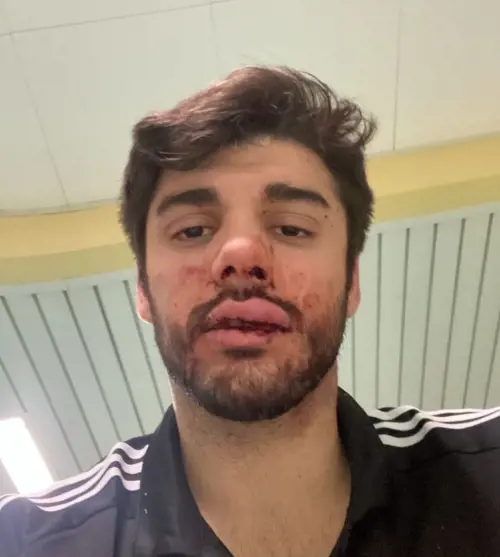 Difende una ragazza dal fidanzato e viene pestato: violenza a Milano