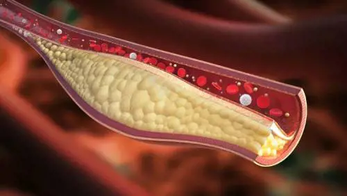 È la nutraceutica la nuova frontiera per combattere il colesterolo. Uno studio lo dimostra