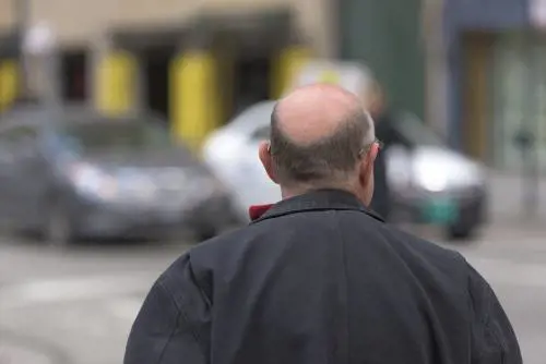 L'allarme sul farmaco contro la caduta dei capelli: cosa provoca