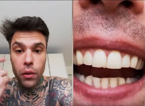 "Un pulmino per Lourdes?": Fedez, il pungo e il dente scheggiato: cos'è successo