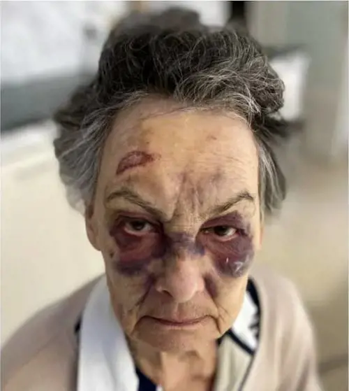 Nega l'elemosina a un senzatetto, lui pesta l'83enne con la stampella
