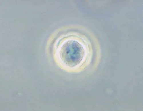 Cheratite da Acanthamoeba, primo farmaco salva cornea: di cosa si tratta