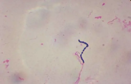 Un "batterio carnivoro" spaventa il mondo: sintomi, cause e cura