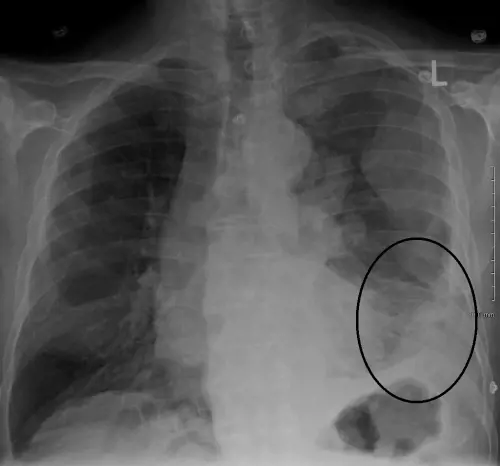 Immagine di James Heilman, MD - Wikimedia Commons