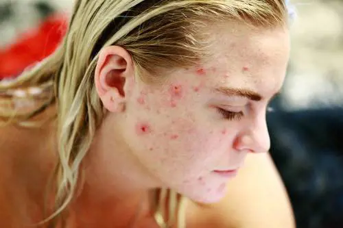 Acne, prendere il sole fa male o è salutare?