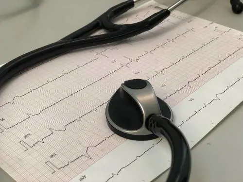 Fibrillazione atriale: ora si può prevedere 30 minuti prima che si verifichi