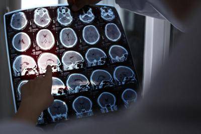 Alzheimer, lo studio italiano che cambia tutto: il ruolo chiave di una proteina
