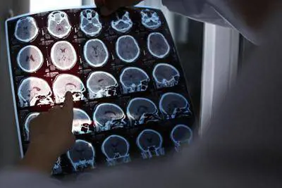 Alzheimer, lo studio italiano che cambia tutto: il ruolo chiave di una proteina