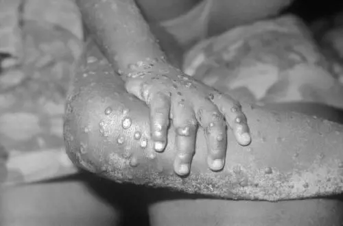 Vaiolo delle scimmie, confermato il primo caso in Europa: cos'è Clade I, il tipo più grave