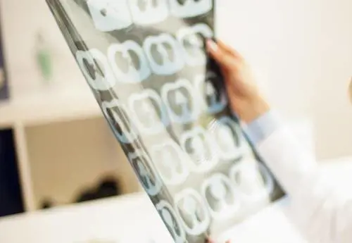 Alzheimer, decadimento motorio come anticamera di quello mentale, anche una decina di anni prima: lo studio