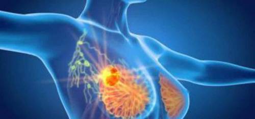Tumore al seno, via libera dell'Ue al nuovo farmaco per contenere le recidive