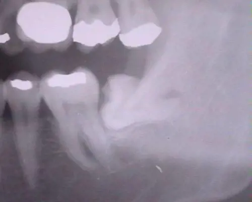 Denti del giudizio, non sempre è necessario rimuoverli. Ecco quando è necessario