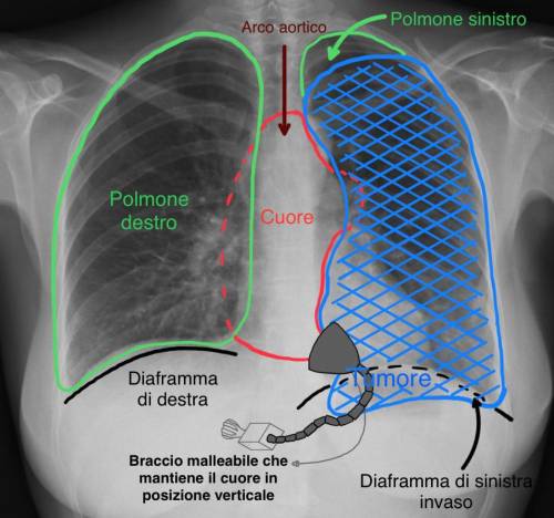 "Nessuno voleva operarmi": a Torino gli asportano un tumore di 20 centrimetri