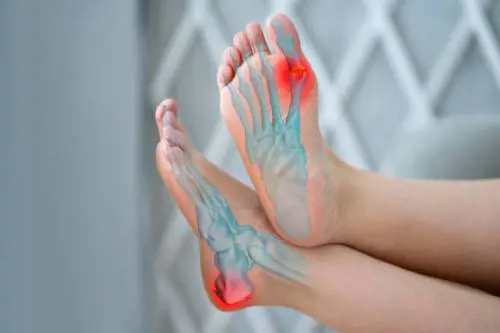 Alluce valgo: di cosa si tratta e come si cura