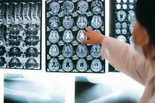 Glioma: cosa è la malattia che ha ucciso l'attrice Kelley Mack