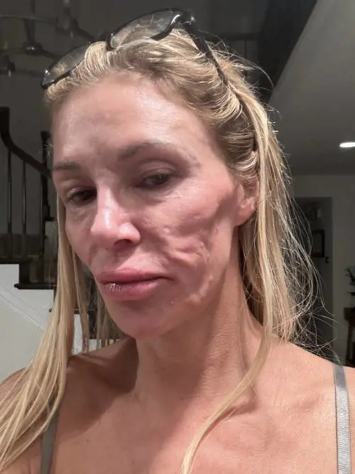 "Ho un parassita nel mio viso", l'agghiacciante storia dell'attrice Brandi Glanville
