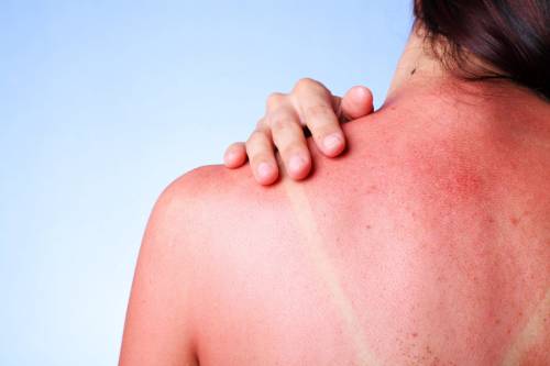 https://img.ilgcdn.com/sites/default/files/styles/md/public/foto/2025/06/15/1750001534-quelle-que-soit-l-intensite-du-coup-de-soleil.jpg?_=1750001534
