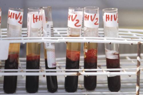 https://img.ilgcdn.com/sites/default/files/styles/md/public/foto/2025/06/24/hiv_sangue_provette_fg_3-4-4002775367_3-5-2564837453_3-5-2681114469_3-5-3521400790_0.jpg?_=1750768203