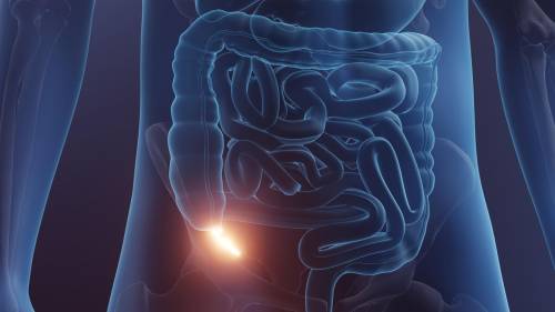 Cancro dell'appendice: cosa rivelano i nuovi studi