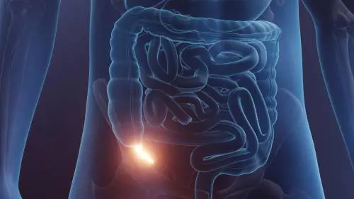 Cancro dell'appendice: cosa rivelano i nuovi studi