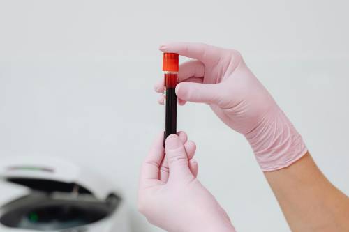 Potassio alto nel sangue: attenzione a questi sintomi