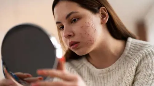 Nuovo trattamento innovativo contro l'acne in arrivo in Europa