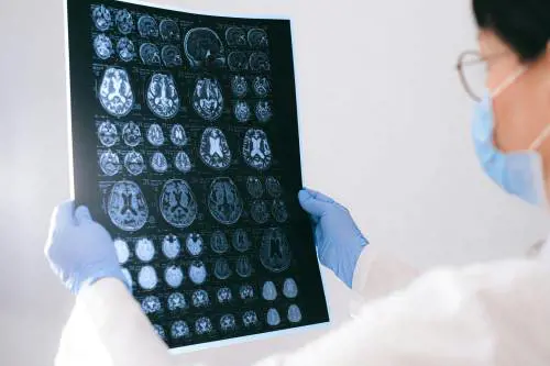 Cos'è l'amiloide, la proteina il cui accumulo eccessivo può portare all'Alzheimer