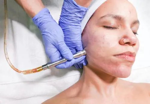 Acne, diagnosi in aumento soprattutto sulle donne: nuove cure e 10 errori da evitare secondo la dermatologa
