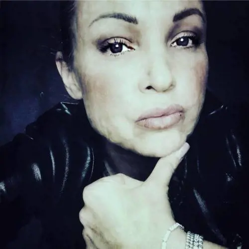 La storia dell'ex modella: "Sfigurata dal chirurgo estetico e senza riscarcimento"