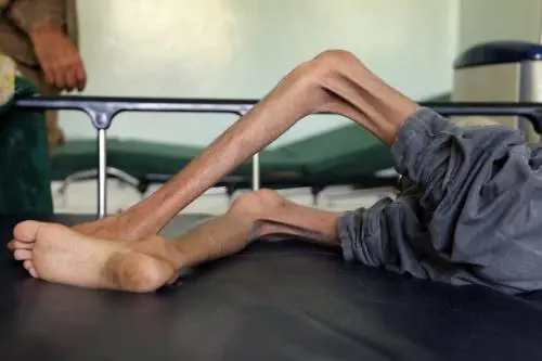 Amal muore di fame, se ne va la bambina simbolo della guerra nello Yemen