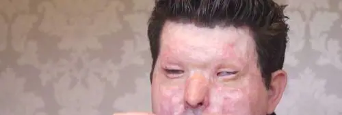 Acido sul viso, il nuovo folle gioco che sta imperversando a Londra