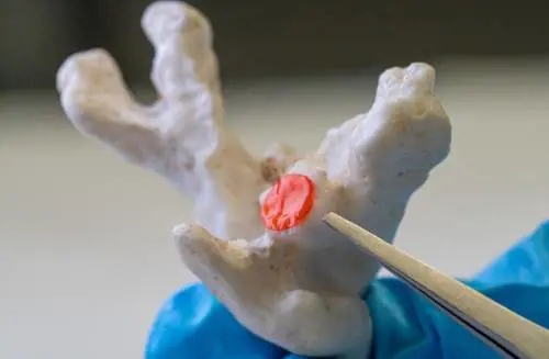 Un cerotto per curare i coralli "feriti" in mare