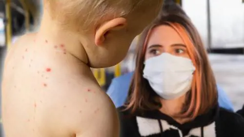 Vaiolo delle scimmie, tira aria di restrizioni: “Misure come quelle del Covid”