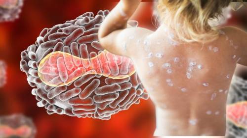 Vaiolo delle scimmie, ci risiamo: preparano la nuova emergenza