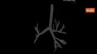 Primo trapianto trachea al mondo su paziente post Covid a Roma