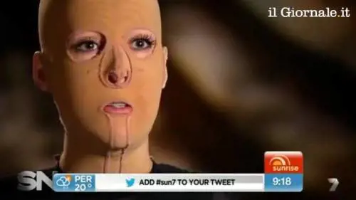 Sfigurata con il fuoco, torna a far vedere il suo volto