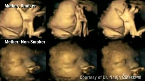 Il fumo fa male al feto: ecco gli effetti nell'ecografia 4D