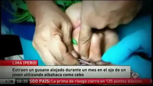 Così è stato rimosso il verme dall'occhio