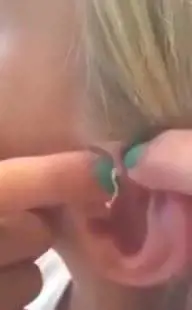 Schiaccia un brufolo vecchio di sei anni: il video è disgustoso