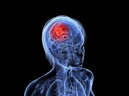 Operata di tumore: trovato un embrione dentro al cervello
