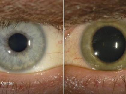 Gli occhi infetti del virus Ebola