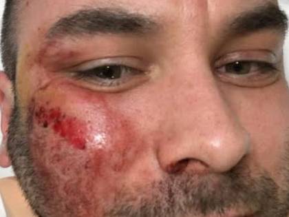 Caccia la rom che gli defeca in casa. Pestato a sangue dai nomadi