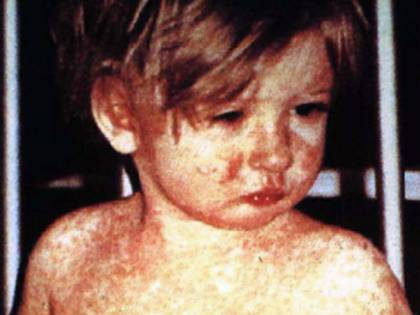 Morbillo, allarme dagli Usa: "Vaccinatevi prima di andare in Italia"
