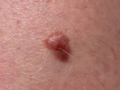 Un nuovo test del sangue per identificare il melanoma